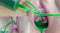 hd cervix and pee hole inflation with injections for japanese lesbians sex